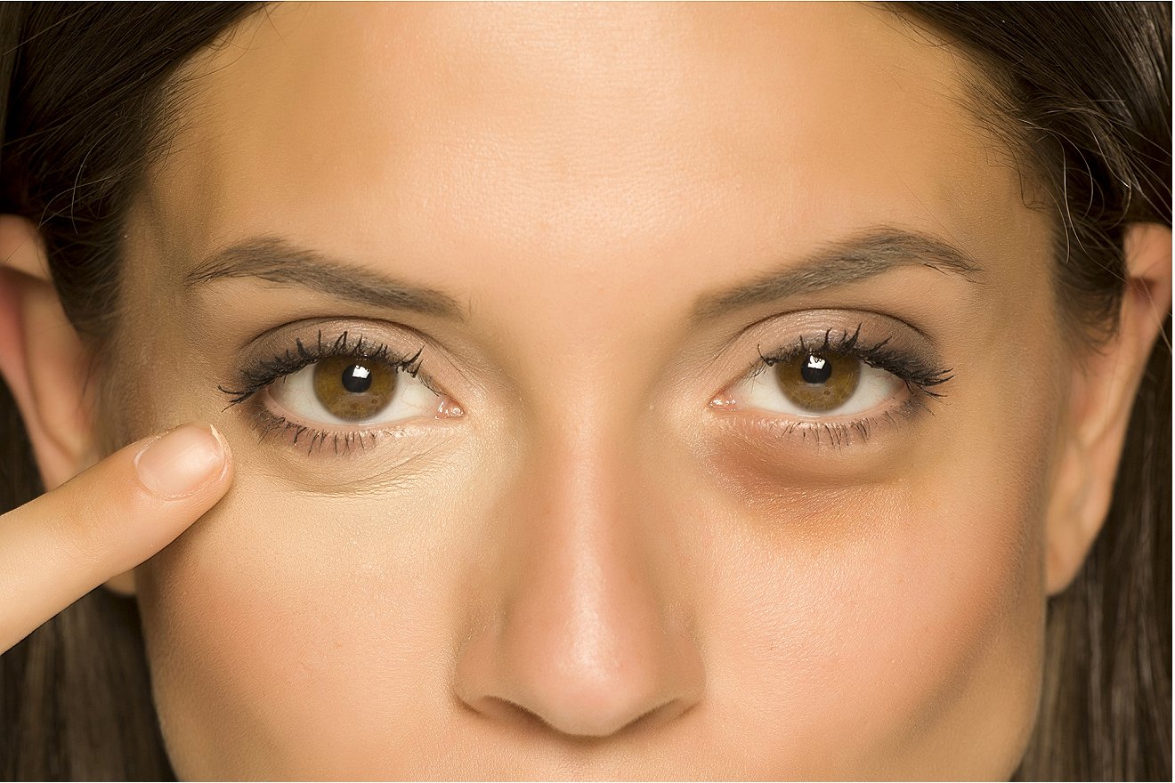 Learn How to Get Rid of Eye Bags